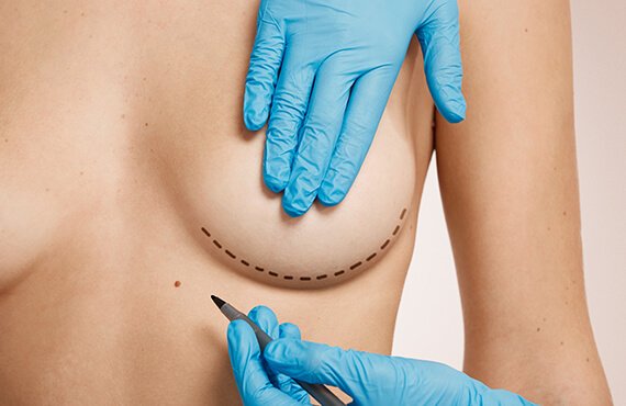 How Breast Lift Surgery Is Performed- Dr Meghna Bagalkotkar