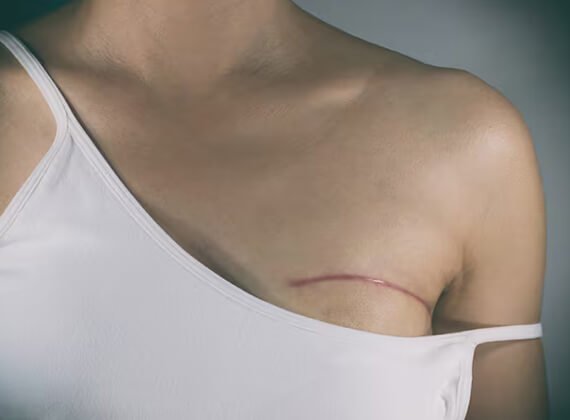 Cancer Reconstruction Surgery in India - Cancer Treatment - Dr Meghna Bagalkotkar