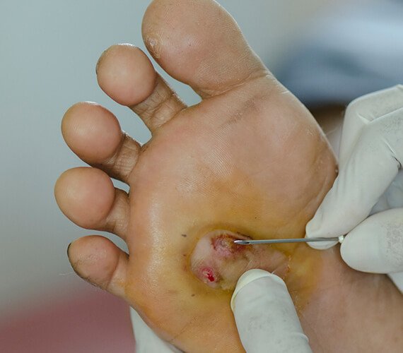 Diabetic Foot Treatment in India - Dr Meghna Bagalkotkar