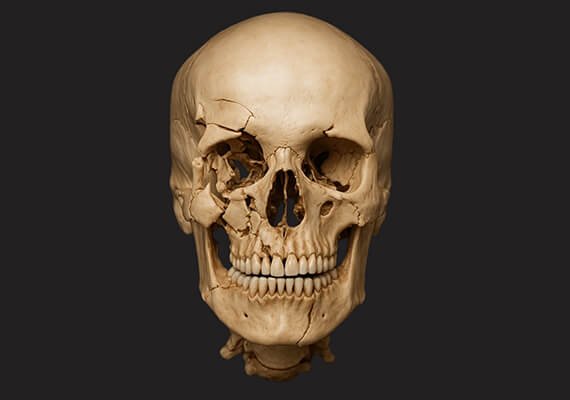 Facial Fracture Surgery in India - Dr Meghna Bagalkotkar