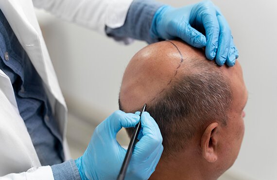 Hair Transplantation in India - Dr Meghna Bagalkotkar