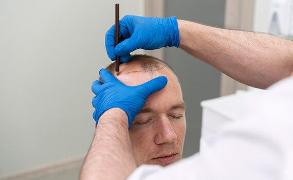 How Hair Transplant Surgery Is Performed - Dr Meghna Bagalkotkar How Hair Transplant Surgery Is Performed - Dr Meghna Bagalkotkar