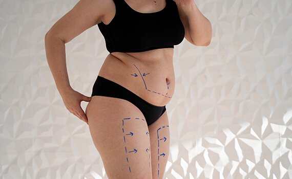 How is Body Lift Surgery Performed - Dr Meghna Bagalkotkar