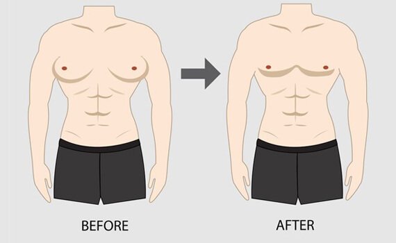 How is Gynecomastia Surgery Done - Dr Meghna Bagalkotkar
