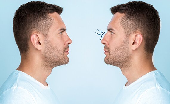 How is Rhinoplasty Surgery Done - Dr Meghna Bagalkotkar