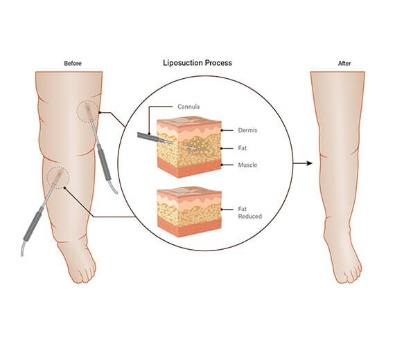 Lymphedema Surgery in India - Dr Meghna Bagalkotkar