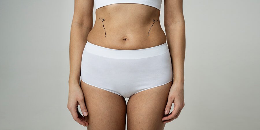 Procedure of Body Lift Surgery - Dr Meghna Bagalkotkar