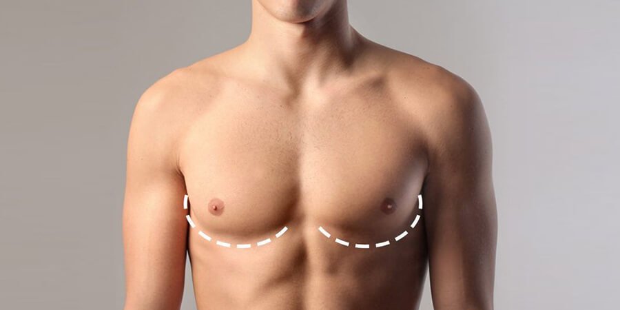 Procedure of Gynecomastia Surgery-Dr-Meghna-Bagalkotkar Procedure of Gynecomastia Surgery-Dr-Meghna-Bagalkotkar