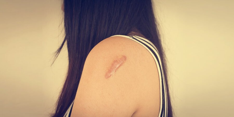 Procedure of Scar Therapy - Dr Meghna Bagalkotkar