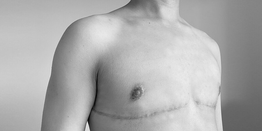 Procedure of Top Surgery - Dr Meghna Bagalkotkar