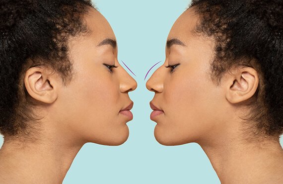 Rhinoplasty Surgery in India - Dr Meghna Bagalkotkar