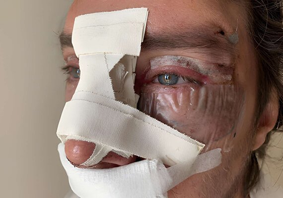 Trauma Reconstruction Surgery in India - Restore Function After Injury with Dr Meghna