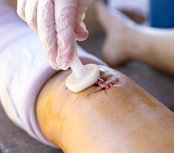 Wound Management in India - Healing Chronic and Non-Healing Wounds Effectively -Dr Meghna Bagalkotkar